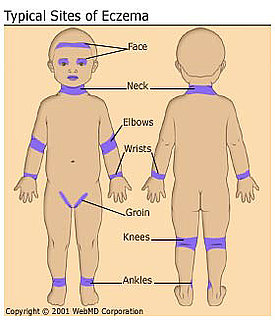 Treatment of Baby Eczema