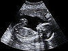 Laws That Bully Women Seeking Abortions