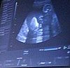 When Baby Fails the Heartbeat Test