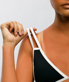 How to Treat a Sunburn 2010-06-30 12:01:35