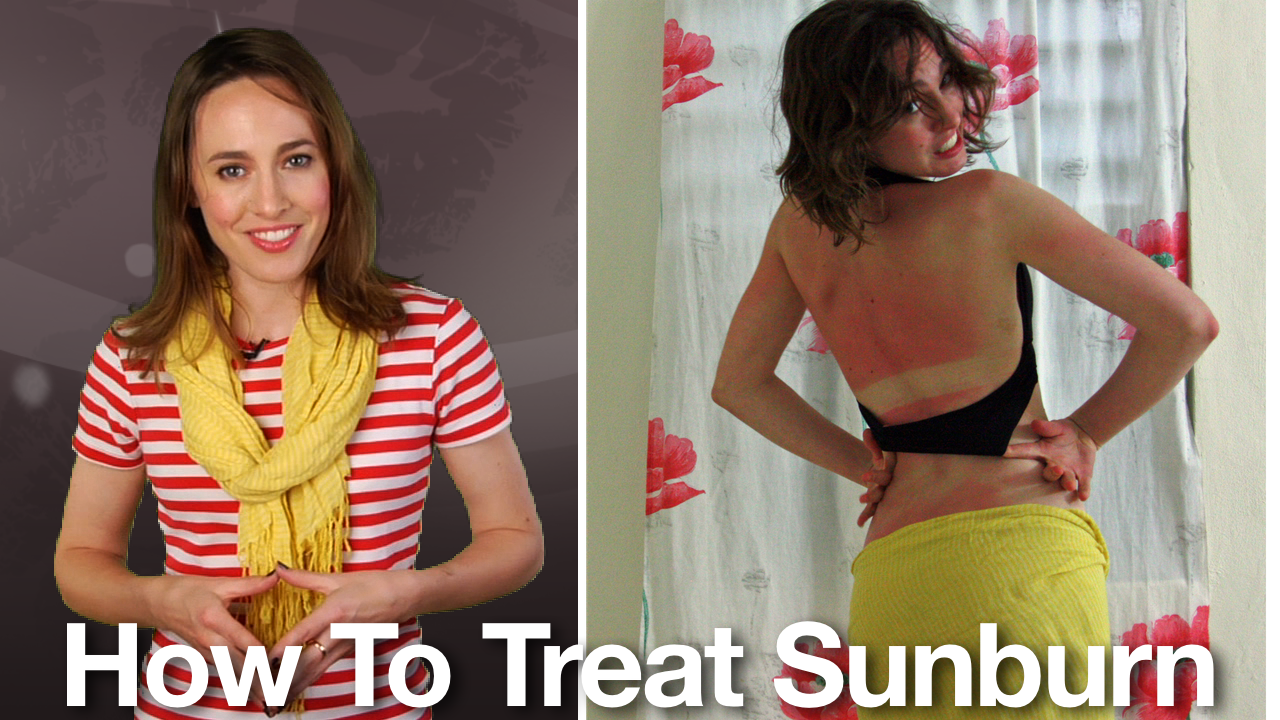 How to Treat Sunburn