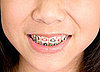 Young Children Getting Braces
