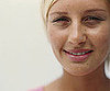 Skin Moles Linked to Reduced Aging of the Skin