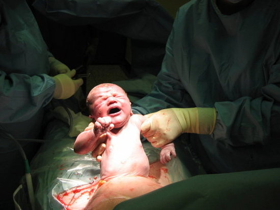 Did you forego a VBAC for an elective second C-section?