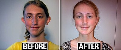Non-Profit Provides Free Plastic Surgery to Kids Bullied Over Their Looks (VIDEO)