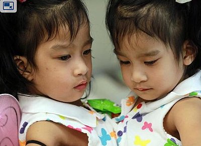 Conjoined Twins Sucessfuly Separated After Marathon Surgery (PHOTO)