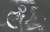 Doctors Save Baby In Utero with First-of-its-Kind Surgery