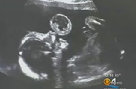 Doctors Save Baby In Utero with First-of-its-Kind Surgery Doctors Save Baby In Utero with First-of-its-Kind Surgery