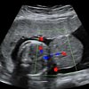 Baby Born With Organs Outside His Body