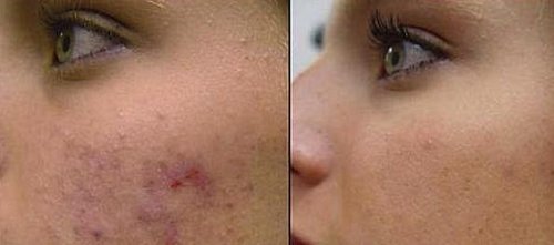 Acne Removal Facial 