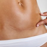 C-Section Recovery C-Section Recovery