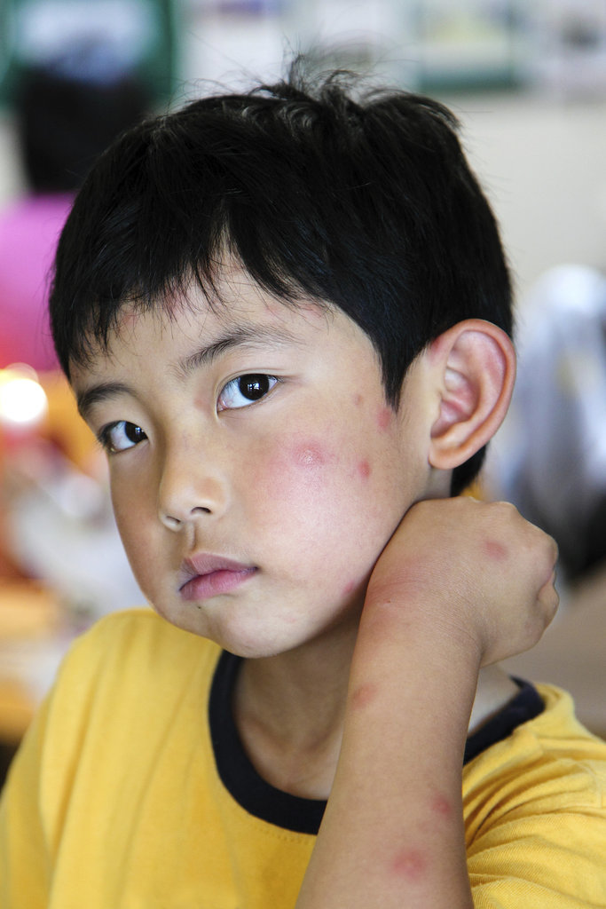 Bug Bites Bug Bites