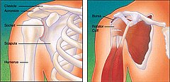 Torn Rotator Cuff = Painful Shoulder