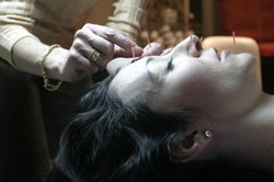 Acufacials Are All The Rage