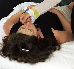 Exercise and Acupuncture Help PCOS Exercise and Acupuncture Help PCOS