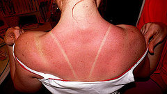 How to Avoid Sun Poisoning