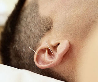 An Unlikely Pair: The Army and Acupuncture