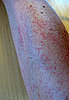 Photos of Rash
