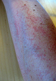 Rashes Caused by Touching Zucchini Plants