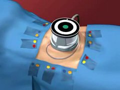 Liposuction Out - Ultrashape In