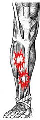 How Can I Prevent Shin Splints? How Can I Prevent Shin Splints?