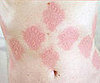 Turning Lemons Into Lemonade: Skin Art 