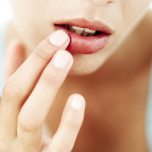 Preventing and Healing Chapped Lips