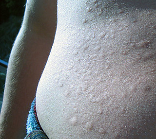 Swimmer's Issue: Allergy to Cold Water?