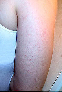 You Asked: Should I Worry About These Bumps on My Arm? 