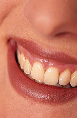 Professional Teeth Whitening: What You Should Know