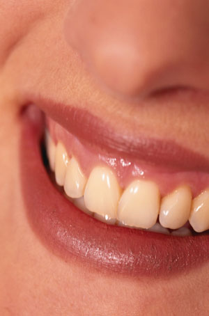 Professional Teeth Whitening: What You Should Know