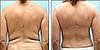 Would You Consider Back Fat Surgery?