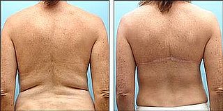Would You Consider Back Fat Surgery?