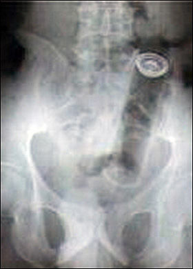 Guess What X-Rays Reveal Is Stuck in This Woman's Bum?
