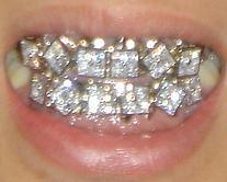 Gallery of Grillz Gallery of Grillz