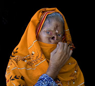 Burn Victims Become Beauticians in Pakistan