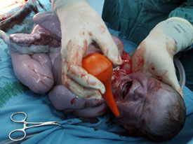 Baby Wellness: Scheduling a C-Section