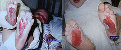 Who Is Responsible for 2nd Degree Burns on Kids' Feet?  