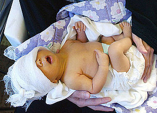 What Do You Know About Newborn Jaundice?