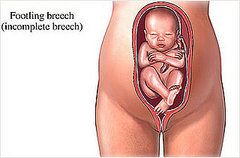Breech Babies Breech Babies