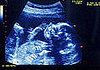 Law to Require Woman to Look at Baby Right Before Abortion 