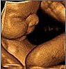 Would You Pay Out of Pocket for a 4D Ultrasound?