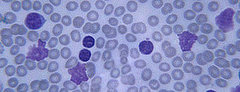 Cancer News: The Good, the Bad, and Early Detection