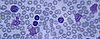 Cancer News: The Good, the Bad, and Early Detection