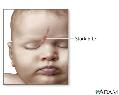 Birthmarks and Stork Bites