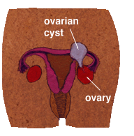 Ovarian Cysts:  What Every Women Should Know