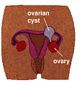 Ovarian Cysts:  What Every Women Should Know