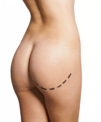 To Overweight Teens: Liposuction Not the Answer
