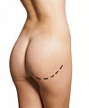 To Overweight Teens: Liposuction Not the Answer