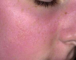 Avoid Sun Poisoning